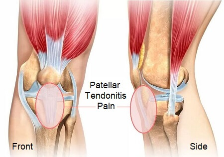 Flank pain - Cause, Symptoms, Diagnosis, Treatment