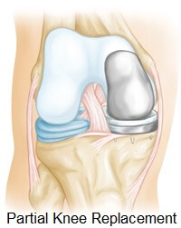 Partial knee replacements are done when arthritis is confined to one side of the knee joint