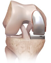 Partial Knee replacement recovery is usually extremely good