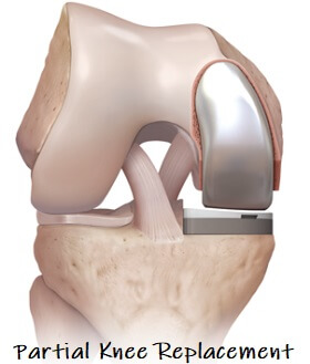 Partial Knee Replacement Surgery - Find out what happens before, during and after surgery Partial Knee Replacement Surgery - Find out what happens before, during and after surgery
