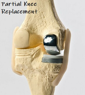 https://www.knee-pain-explained.com/images/partial-knee-replacement.jpg