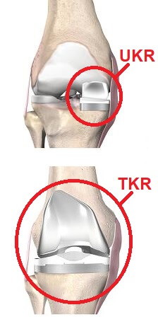 Total vs partial knee replacement surgery
