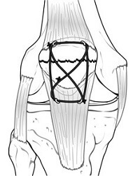 A figure-of-eight tension band holds the transverse patellar fracture together.