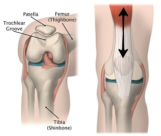 Patellofemoral Arthritis: Causes & Treatment - Knee Pain Explained