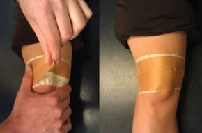 Taping the patella into a medial glide position helps to stretch out the lateral retinaculum and hold the kneecap in the correct place Taping the patella into a medial glide position helps to stretch out the lateral retinaculum and hold the kneecap in the correct place