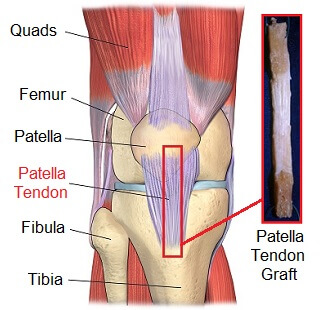 Patellar tendon graft used in ACL reconstruction surgery