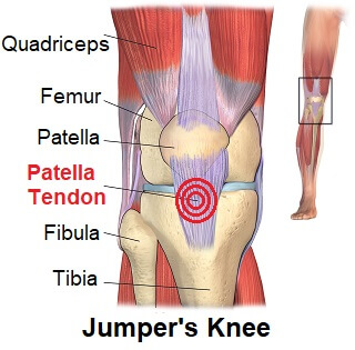 Knee Symptoms Chart