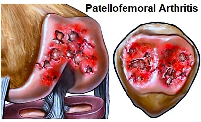 patellofemoral arthrosis hogyan kell kezelni)