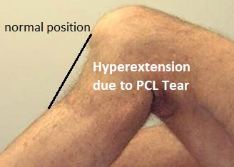 You can see here the tibia (shin bone) has glided back too far due to a PCL injury You can see here the tibia (shin bone) has glided back too far due to a PCL injury