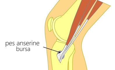Pes Anserine Bursitis is one of the less common causes of medial knee pain
