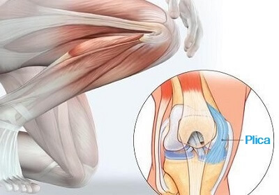 Knee Plica Syndrome Causes Symptoms Treatment