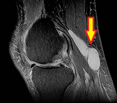 MRI showing a Bakers Cyst - note the white area at the back of the knee on the right hand side