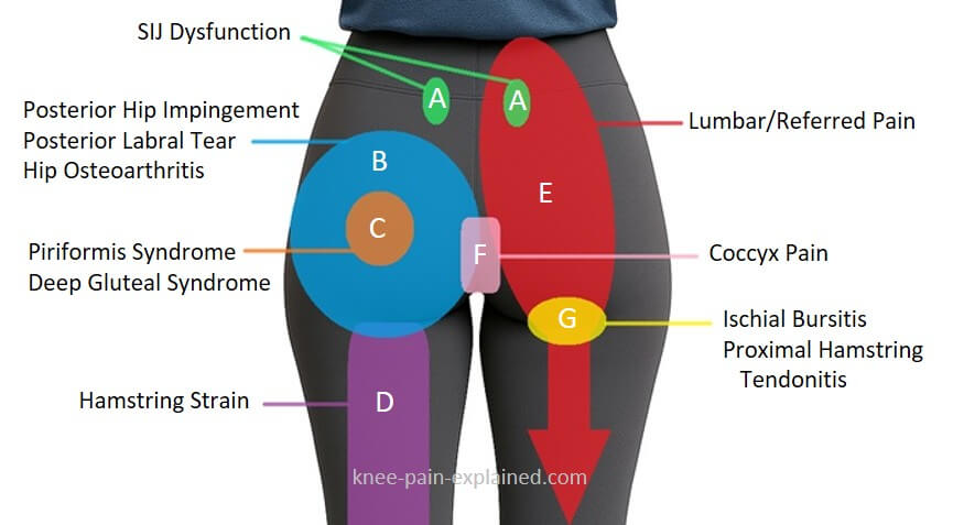 Posterior Hip Pain Location Chart: Find out what is causing pain in the back of your hip/buttocks with our handy hip pain diagnosis chart Posterior Hip Pain Location Chart: Find out what is causing pain in the back of your hip/buttocks with our handy hip pain diagnosis chart