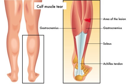 Causes Of Pain Behind The Knee: Calf Tear. A tear in the calf muscle causes pain behind the knee and in the back of the calf. Causes Of Pain Behind The Knee: Calf Tear. A tear in the calf muscle causes pain behind the knee and in the back of the calf.