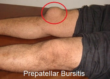 Prepatellar Bursitis Housemaids Knee Treatment