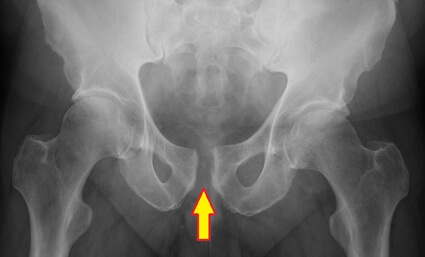 Pubic Symphysis Diastasis: X-ray showing separation at the pubic symphysis. If the gap is more that 10mm it indicates symphysis pubis dysfunction from instability Pubic Symphysis Diastasis: X-ray showing separation at the pubic symphysis. If the gap is more that 10mm it indicates symphysis pubis dysfunction from instability
