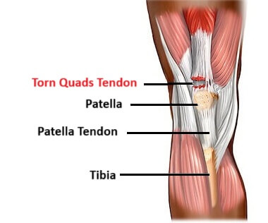 Partial Quadriceps Tendon Rupture: Causes, Symptoms, Diagnosis & Treatment