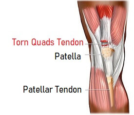 Quads Tendon Rupture: Causes, Symptoms & Treatment Options Quads Tendon Rupture: Causes, Symptoms & Treatment Options
