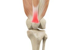 Quadriceps Tendonitis: Causes, Symptoms &  Treatment
