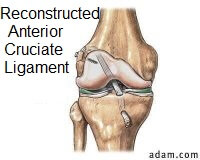 ACL Reconstruction Surgery reconstructed ACL 200 opt apr 18
