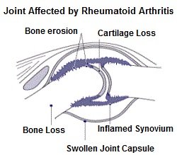 The affect of Rheumatoid Arthritis on joints