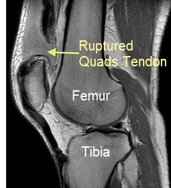 MRI showing quadriceps tendon rupture