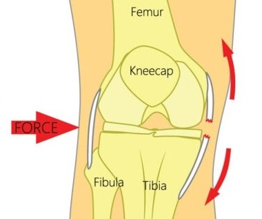 Swelling On Inside Of Knee: MCL Tear
