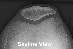 Skyline view showing the back of the patella