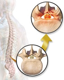 Spinal problems cause buttock pain similar to ischial bursitis