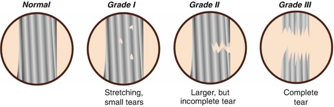 Hip Flexor Strain Grades 1-3