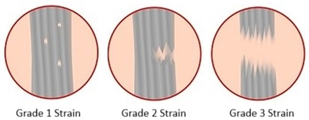 Upper thigh muscle pain is often due to a muscle strain, where the muscle is overstretched or overloaded causing it to tear. Upper thigh muscle pain is often due to a muscle strain, where the muscle is overstretched or overloaded causing it to tear.