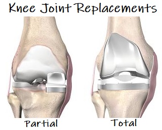 Knee Joint Replacement Surgery - Knee Pain Explained