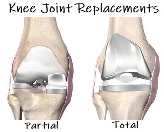 knee joint replacement devices