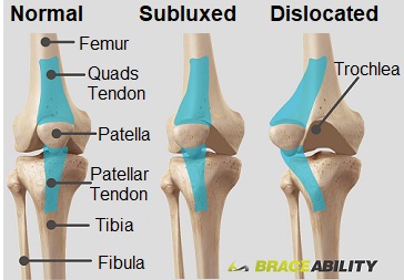 Dislocated Patella (Kneecap): Causes & Treatment - Knee Pain Explained