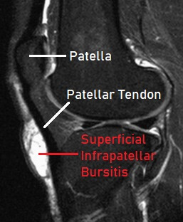 MRI scan showing an inflamed superficial infrapatellar bursa MRI scan showing an inflamed superficial infrapatellar bursa