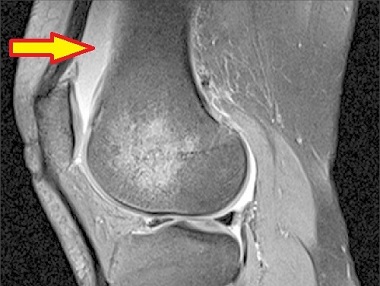 Suprapatellar Bursitis Diagnosis: MRI showing fluid accumulation in the quadriceps tendon bursa
