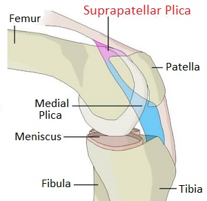 Swelling Above Knee: Suprapatellar Plica Syndrome. Causes, Symptoms, Diagnosis & Treatment Swelling Above Knee: Suprapatellar Plica Syndrome. Causes, Symptoms, Diagnosis & Treatment