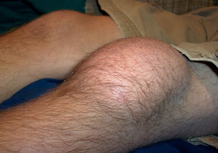 Swelling In Front Of Knee: Causes & Treatment