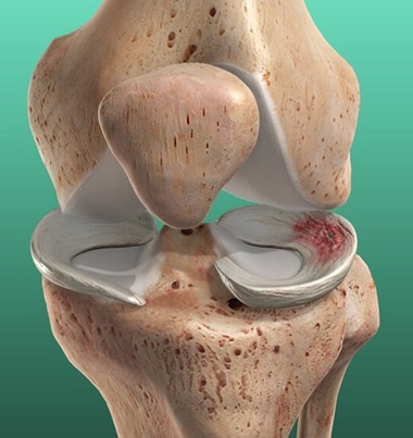 A meniscus tear can cause knee pain and popping with the torn flap of cartilage getting stuck in the joint