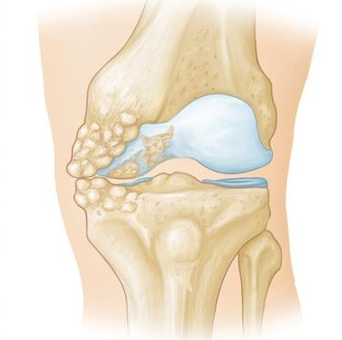 Knee Arthritis Swelling At Side Of Knee: Causes, Symptoms, Diagnosis & Treatment