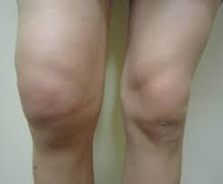 Swollen Knee Causes Treatment Knee Pain Explained