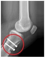 Tibial Tubercle Transfer surgery can help to reduce the risk of recurrent patellar dislocation