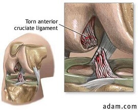 Arthroscopic picture of left knee revealing (a) bulky anterior cruciate