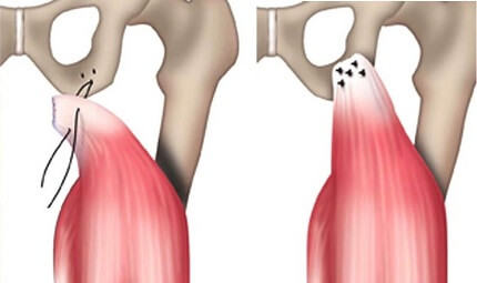 Torn Hamstring Surgery: for proximal hamstring tendon avulsion injury