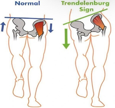 Weakness in the muscles around the hip can lead to hip drop known as Trendelenberg's Sign. Weakness in the muscles around the hip can lead to hip drop known as Trendelenberg's Sign.