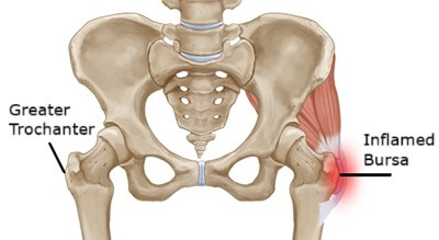 Gluteal tendinopathy is often accompanied by trochanteric bursitis - inflammation of the bursa that sits between the gluteal tendons and the greater trochanter Gluteal tendinopathy is often accompanied by trochanteric bursitis - inflammation of the bursa that sits between the gluteal tendons and the greater trochanter