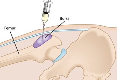 Trochanteric Bursitis Treatment: Corticosteroid injections can be helpful with chronic cases of hip bursitis. Image courtesy of AAOS Trochanteric Bursitis Treatment: Corticosteroid injections can be helpful with chronic cases of hip bursitis. Image courtesy of AAOS