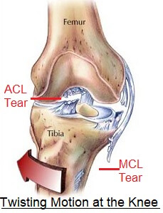 Potential detrimental effects of ligament injury on the knee.