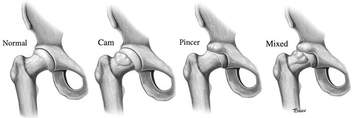 Lateral Hip Pain: Femoroacetabular Impingement can cause outer hip pain Lateral Hip Pain: Femoroacetabular Impingement can cause outer hip pain