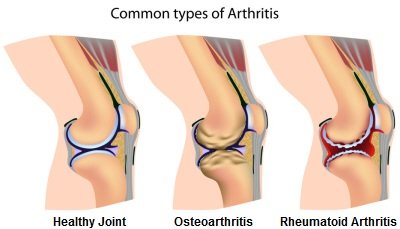 Arthritis Pain in Knee Symptoms, Diagnosis \u0026 Treatment